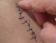 applied-sutured-wound-sm