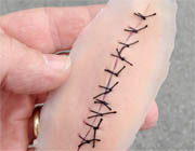 sutured-wound-sm
