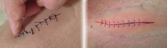 suture-staple-banner